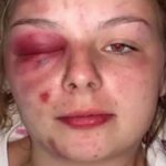 Injured In Eye With Hammer